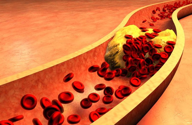 TopDoktor radí ako bojovať s cholesterolom